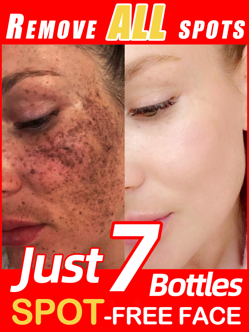 Lighten Freckles Melasma, Faci - Skincare Luxury Whitening recension och pris